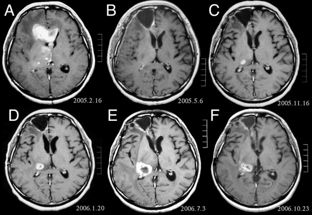 Anaplastic_astrocytoma.jpg