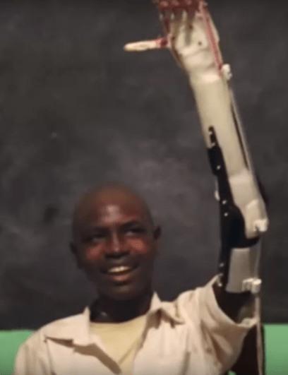 3d printing prosthetic.png